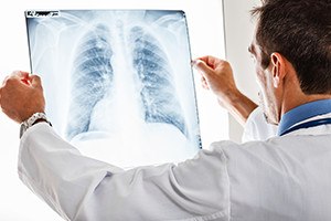 Doctor examining a lung radiography