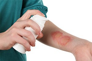 Treatment of burns by spray