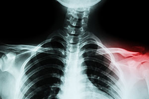 Clavicle Injuries