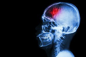 Stroke cerebrovascular accident film x-ray skull lateral