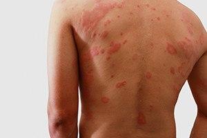 Man with desmatitis problem