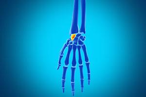 Scaphoid Fractures