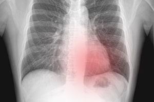 Hemothorax and Pneumothorax
