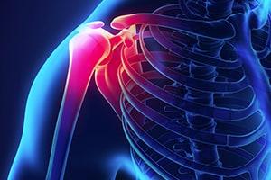 Bursitis